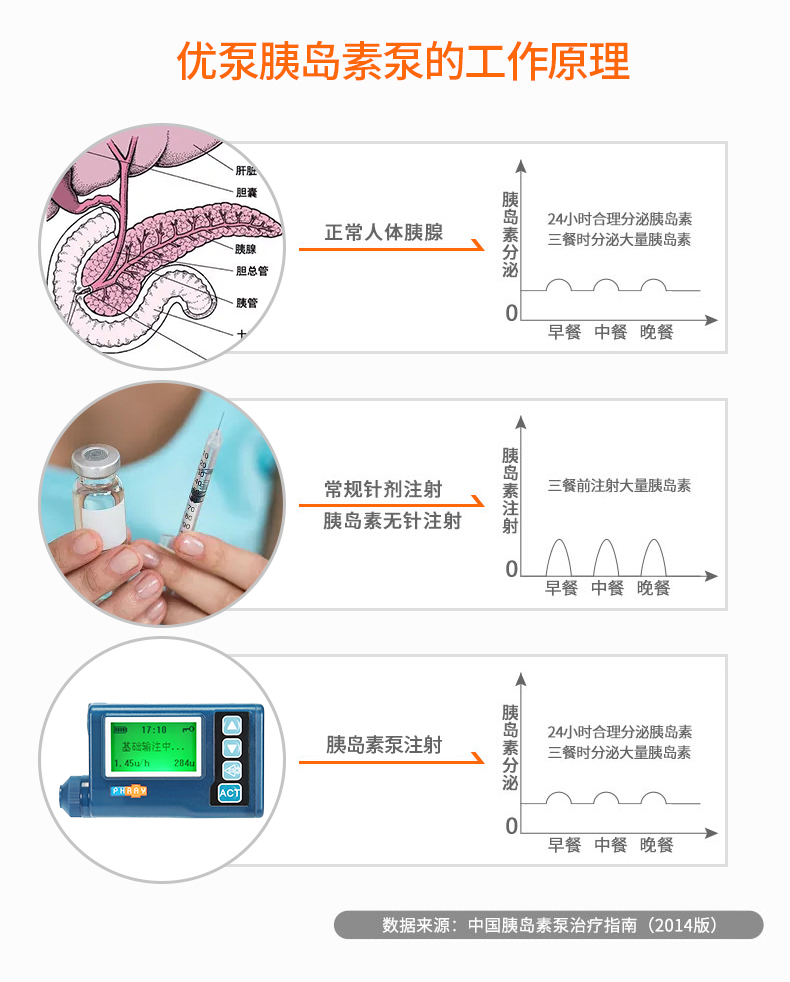 选择胰岛素泵治疗有什么优势?
